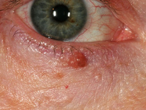 Basal cell carcinoma affecting the eyelid 