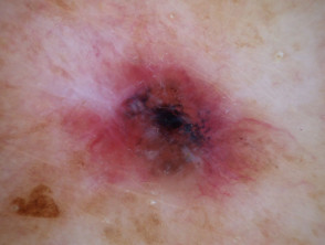 Basal cell carcinoma affecting the face