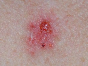 Basal cell carcinoma affecting the trunk