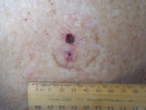 Basal cell carcinoma affecting the trunk