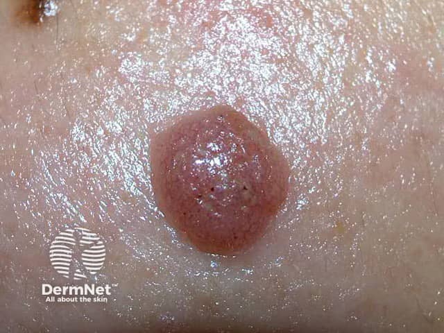 Clear cell acanthoma