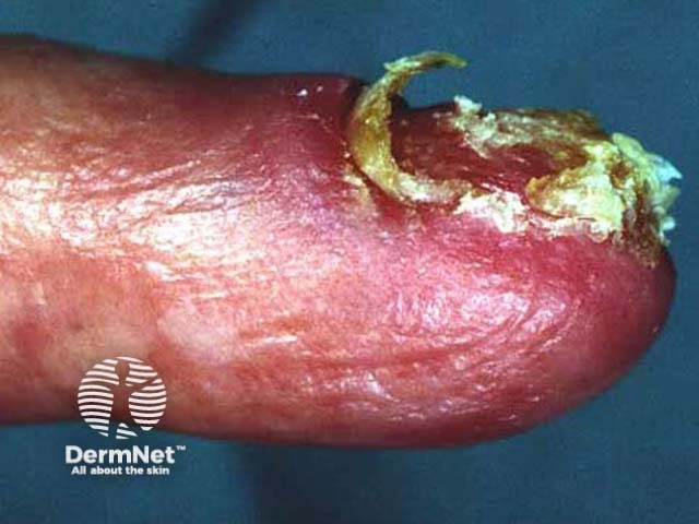 Subungual melanoma