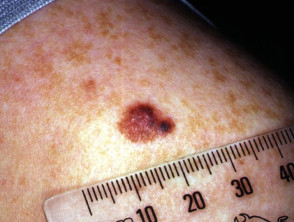 Superficial spreading melanoma in teenager
