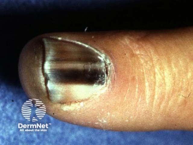 Subungual melanoma