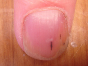 Pigmented splinter haemorrhage