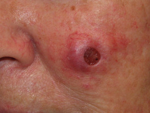 Squamous cell carcinoma on the face