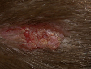 Sebaceous naevus with basal cell carcinoma