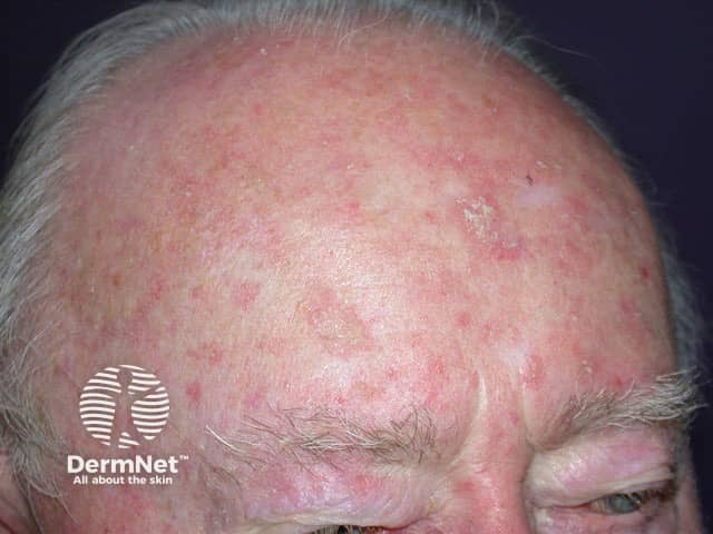 Diffuse keratoses