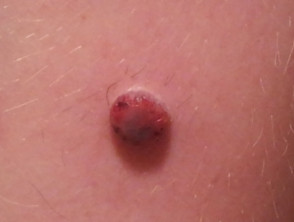 Spitzoid melanoma on the leg of a child