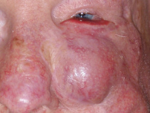 Eyelid melanoma