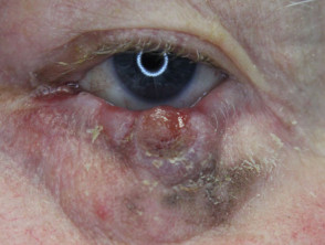 Eyelid melanoma