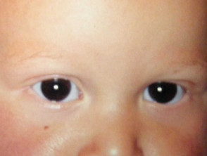 Baby with madarosis due to alopecia areata