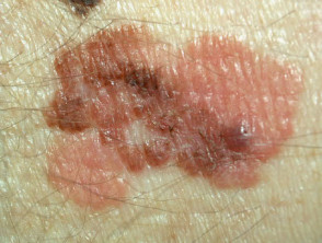 1.6 mm thick superficial spreading melanoma