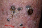 Secondary melanoma in the skin