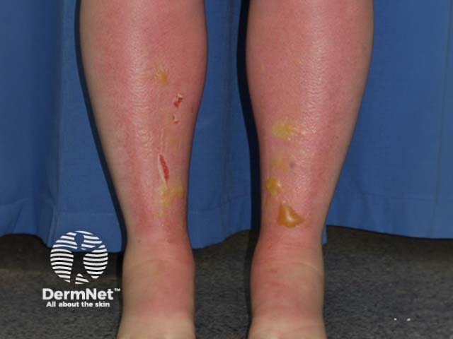 Blistering on the lower leg due to sunburn