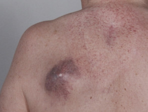 Metastatic melanoma on the chest