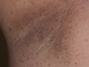 Axillary freckling in neurofibromatosis