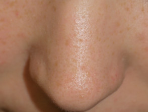 Enlarged pores