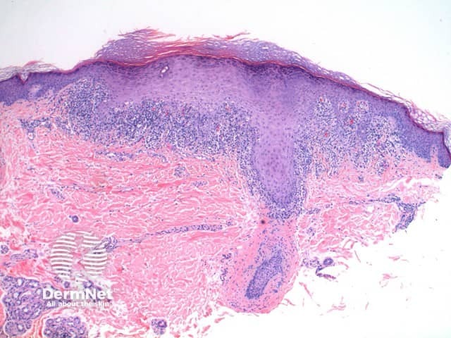 Pathology of lichen planus