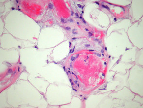 Angiolipoma pathology