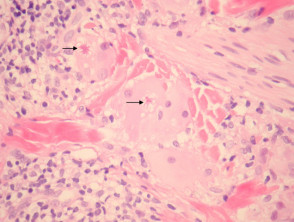 Annular elastolytic giant cell granuloma pathology