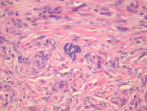 Atypical dermatofibroma pathology