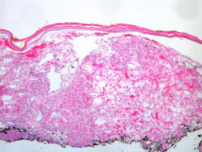 Bacillary angiomatosis