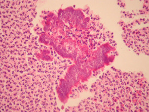 Botryomycosis  pathology