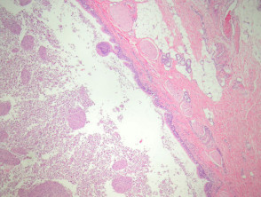 Bronchogenic cyst pathology