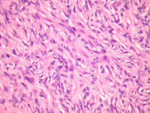 Cellular dermatofibroma pathology