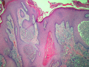 Coccidioidomycosis  pathology