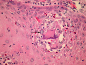 Coccidioidomycosis  pathology