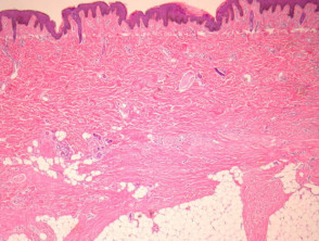 Fibroblastic connective tissue naevus pathology