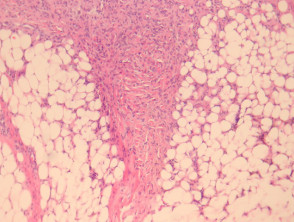 Deep fibrous histiocytoma pathology