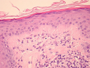 Pathology of discoid lupus erythematosus