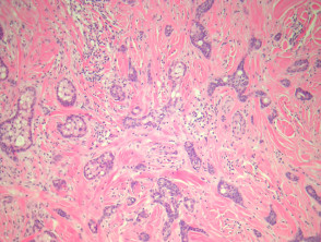 Eccrine carcinoma pathology