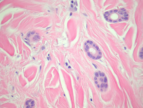 Eccrine carcinoma pathology
