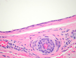 Eccrine hidrocystoma pathology