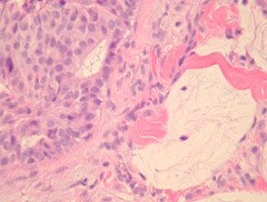 Endocrine mucin–producing sweat gland carcinoma pathology