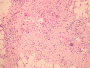 Erythema nodosum  pathology