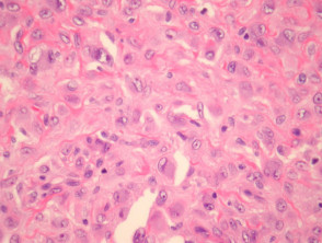 Epithelioid histiocytoma pathology