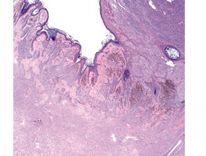 Congenital naevus pathology