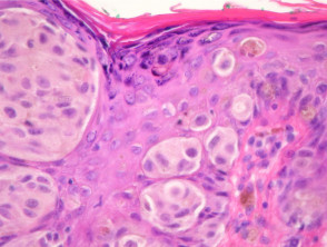 Congenital naevus pathology