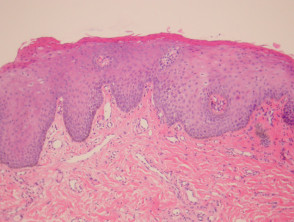 Labial melanotic macule pathology