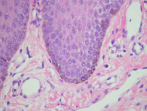 Labial melanotic macule pathology