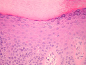 Hyperkeratosis lenticularis perstans (Flegel disease) pathology