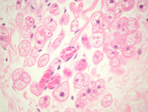 Hibernoma pathology