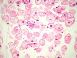 Hibernoma pathology