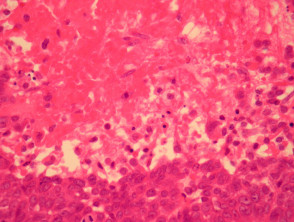 Hidradenocarcinoma pathology