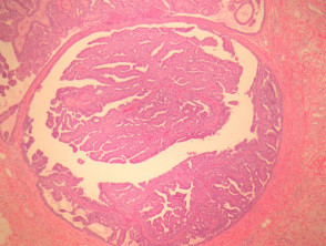 Hidradenoma papilliferum pathology